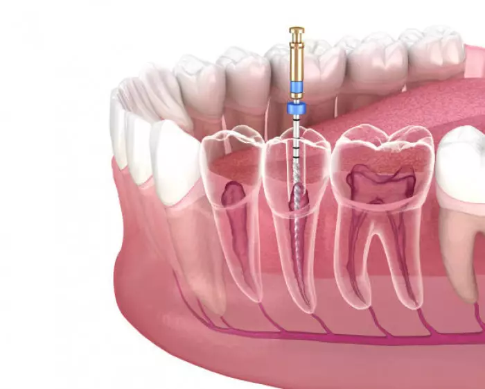 Canal dentário: como é feito e principais cuidados