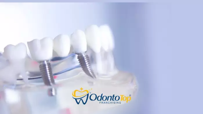 7 cuidados importantes após realizar um implante dentário