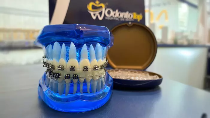 Aparelhos ortodônticos: o guia completo para um sorriso perfeito